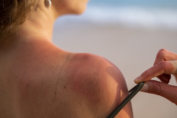 Efek sunburn / Foto: freepik.com