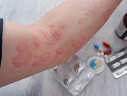 Reaksi Alergi Syok Anafilaktik Bisa Ancam Jiwa, Ini Cara Mencegahnya