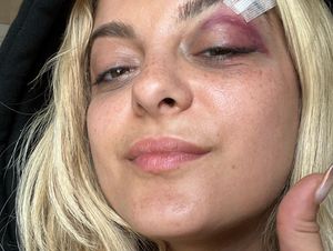 Kondisi Terkini Bebe Rexha Usai Ditimpuk HP oleh Fans Saat Konser Kondisi Terkini Bebe Rexha Usai Ditimpuk HP oleh Fans Saat Konser