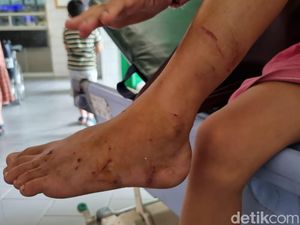 Dinkes Surabaya Pastikan 2 Anak Diserang Monyet Tak Terkena Rabies