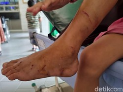 Dinkes Surabaya Pastikan 2 Anak Diserang Monyet Tak Terkena Rabies