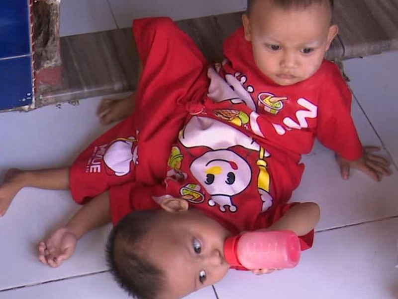 Mari Bantu Adam dan Malika, Anak Kuli Serabutan yang Lahir Kembar Siam