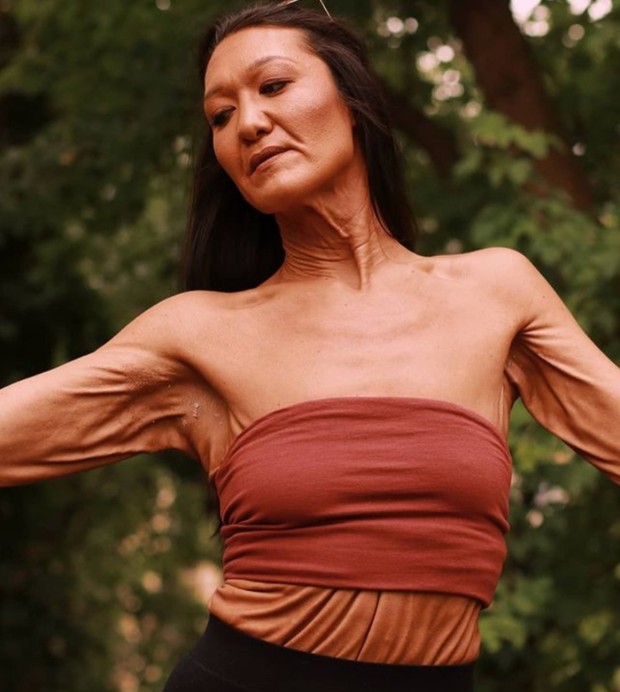 Kisah inspiratif perempuan dengan kondisi kulit genetik