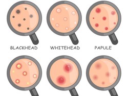 Mengenal 8 Jenis-jenis Jerawat dan Cara Mengobatinya Agar Tidak Bopeng