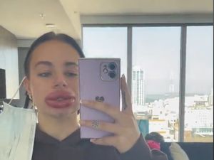 Tergoda Filler Gratis dari Giveaway, Wanita Ini Tak Sangka Bibir Jadi Begini Tergoda Filler Gratis dari Giveaway, Wanita Ini Tak Sangka Bibir Jadi Begini