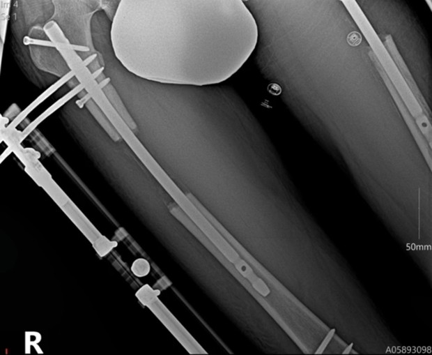 Operasi Pemanjangan Kaki. Foto: Tiktok.com/@mrbrokenbonez