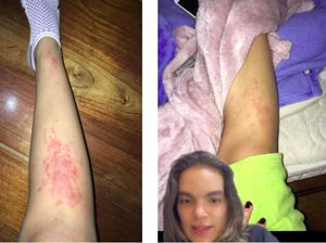 Dikira Ruam Biasa, Ternyata Tubuh Turis Cantik Ini Kemasukan Cacing! Dikira Ruam Biasa, Ternyata Tubuh Turis Cantik Ini Kemasukan Cacing!