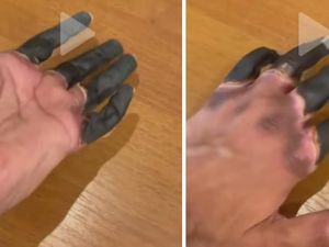 Mengenal Frostbite, Viral di TikTok Jari Menghitam-Membeku Bak Lilin Mengenal Frostbite, Viral di TikTok Jari Menghitam-Membeku Bak Lilin