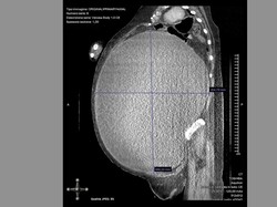 Dikira Obesitas, Ternyata Wanita Ini Idap Kista Ovarium Bobotnya Nyaris 5 Kg