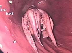 Ngeri, Gurita Besar Bersarang di Tenggorokan Pria Ini