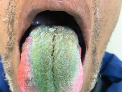 Aneh Tapi Nyata, Lidah Perokok Ini Berubah Jadi Hijau dan Berbulu