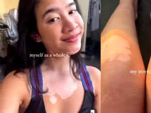 Kena Vitiligo, Dokter Salma Berjuang Lawan Insecure hingga Sukses Jadi Model Kena Vitiligo, Dokter Salma Berjuang Lawan Insecure hingga Sukses Jadi Model