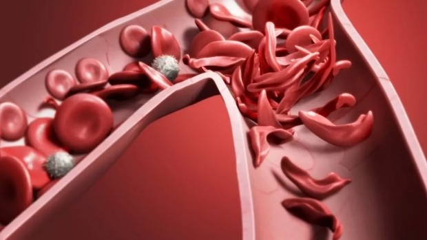 Ilustrasi Anemia Sel Sabil/Foto: Science Photo Library Ilustrasi Anemia Sel Sabil/Foto: Science Photo Library