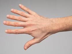 Pria Ini Terlahir dengan Kondisi Langka, Punya 12 Jari dan 2 Alat Kelamin