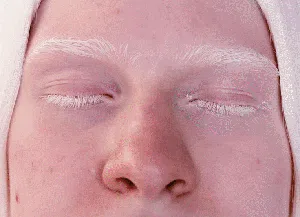 Dag-dig-dug Penderita Albinisme di Tengah Panas Ekstrem Roma Dag-dig-dug Penderita Albinisme di Tengah Panas Ekstrem Roma