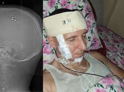 Peneliti Rusia Nekat Pasang Chip di Otaknya Modal Nonton Video di Youtube