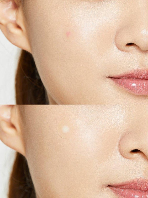 Acne Patch