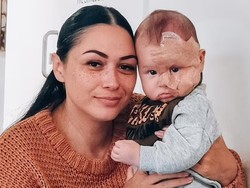 Ibu Ini Disebut Monster karena Laser Wajah Bayinya untuk Hilangkan Tanda Lahir