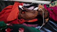 Potret Pilu Anak-anak Kekurangan Gizi Sudan Bertahan Hidup di Pengungsian