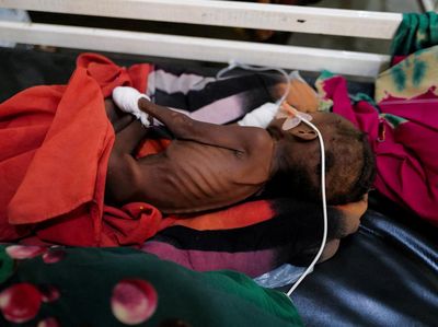 Potret Pilu Anak-anak Kekurangan Gizi Sudan Bertahan Hidup di Pengungsian