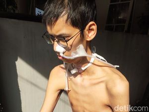 Gara-gara Leher Terjerat Kabel di Jaksel, Mahasiswa Ini Kini Tak Bisa Bicara Gara-gara Leher Terjerat Kabel di Jaksel, Mahasiswa Ini Kini Tak Bisa Bicara