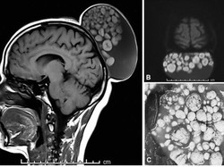 Penampakan Kepala Wanita yang Ditumbuhi Kista, Berisi Rambut dan Gumpalan Lemak