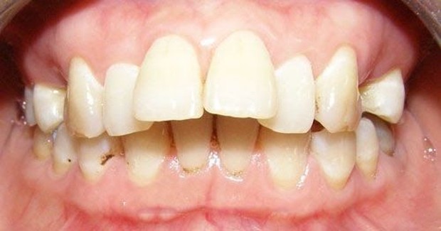 Pertumbuhan Gigi yang Tidak Normal