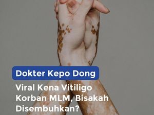 Viral Kena Vitiligo Korban MLM, Bisakah Disembuhkan?