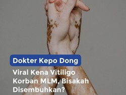 Viral Kena Vitiligo Korban MLM, Bisakah Disembuhkan?