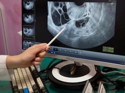 Heboh Wanita Lajang di Taiwan Beramai-ramai Ingin Egg Freezing, Begini Curhatnya