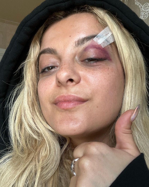 Bebe Rexha Mendapat Jahitan di Bagian Atas Matanya/Foto: Instagram.com/beberexha Bebe Rexha Mendapat Jahitan di Bagian Atas Matanya/Foto: Instagram.com/beberexha
