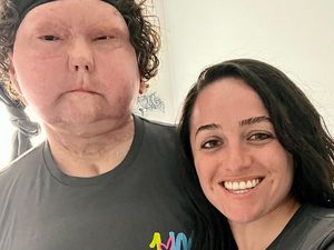 Kisah Wanita yang Jatuh Cinta dengan Pria yang Wajahnya Hasil Transplantasi