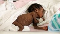Kasihan, Krisis Pangan di Haiti Bikin Anak-anak Malnutrisi