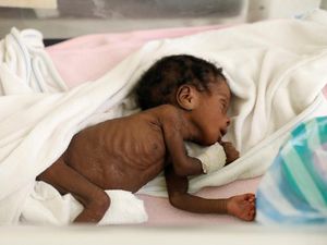 Kasihan, Krisis Pangan di Haiti Bikin Anak-anak Malnutrisi