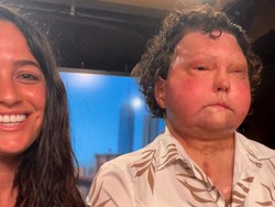 Wanita Terima Lamaran Pria dengan Transplantasi Wajah, Cinta Tak Pandang Fisik