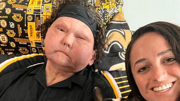 8 Foto Kehidupan Cinta Pria dengan Wajah Transplantasi, Romantis dengan Pacar