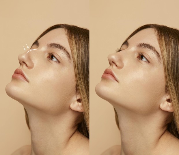 Septoplasty Cara Memancungkan Hidung/Foto: Freepik/freepik Septoplasty Cara Memancungkan Hidung