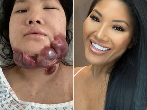 Kisah Model yang Terkena Luka Bakar di Wajah & Jadi Tumor, Tinggalkan Trauma Kisah Model yang Terkena Luka Bakar di Wajah & Jadi Tumor, Tinggalkan Trauma