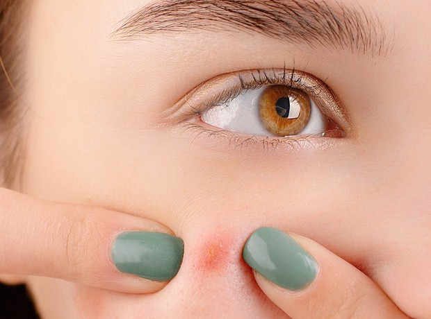 Pengertian skin picking disorder