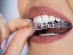 Begini Cara Tepat Menggunakan Clear Aligner Biar Gigi Rapi Maksimal