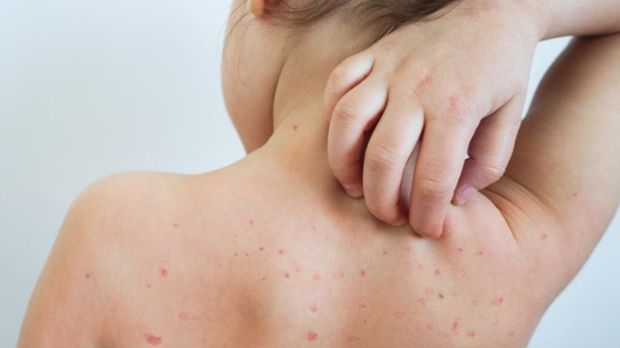Cara mengobati cacar air/iStock