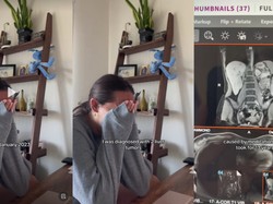 Kisah Pilu Wanita 13 Tahun Pakai KB, Berakhir Idap Tumor Hati