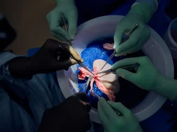 Cetak Sejarah, Cangkok Ginjal Babi Berfungsi Lebih dari Sebulan di Tubuh Manusia