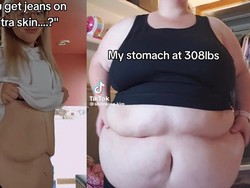 Awal Mula Viral Wanita Open Donasi Rp 123 Juta buat Operasi Kulit Gelambir