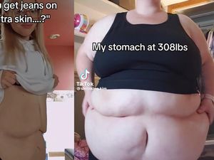 Awal Mula Viral Wanita Open Donasi Rp 123 Juta buat Operasi Kulit Gelambir Awal Mula Viral Wanita Open Donasi Rp 123 Juta buat Operasi Kulit Gelambir
