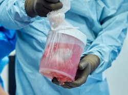 Cangkok Ginjal Babi ke Manusia Berhasil Bertahan 32 Hari