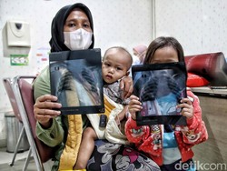 Dokter Paru Beberkan Efek Polusi Udara pada Anak, Bisa Picu Asma-ISPA