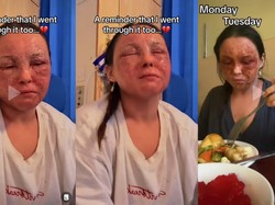 Wanita Ini Idap Eksim Parah, Kulitnya Sampai Melepuh Hingga Hampir Buta