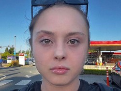 Penampakan Ngeri Wanita Penderita Eksim Parah, Kulit Wajah Melepuh