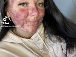 Berjerawat Parah Hingga Diejek Wajah Pizza, Wanita Ini Sukses Jadi Influencer